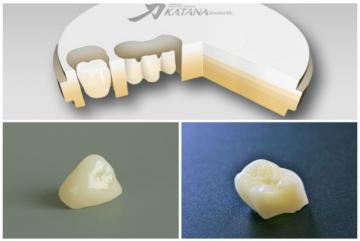 Defekte Zahnfüllung: so hilft die digitale Zahnmedizin - 360°zahn